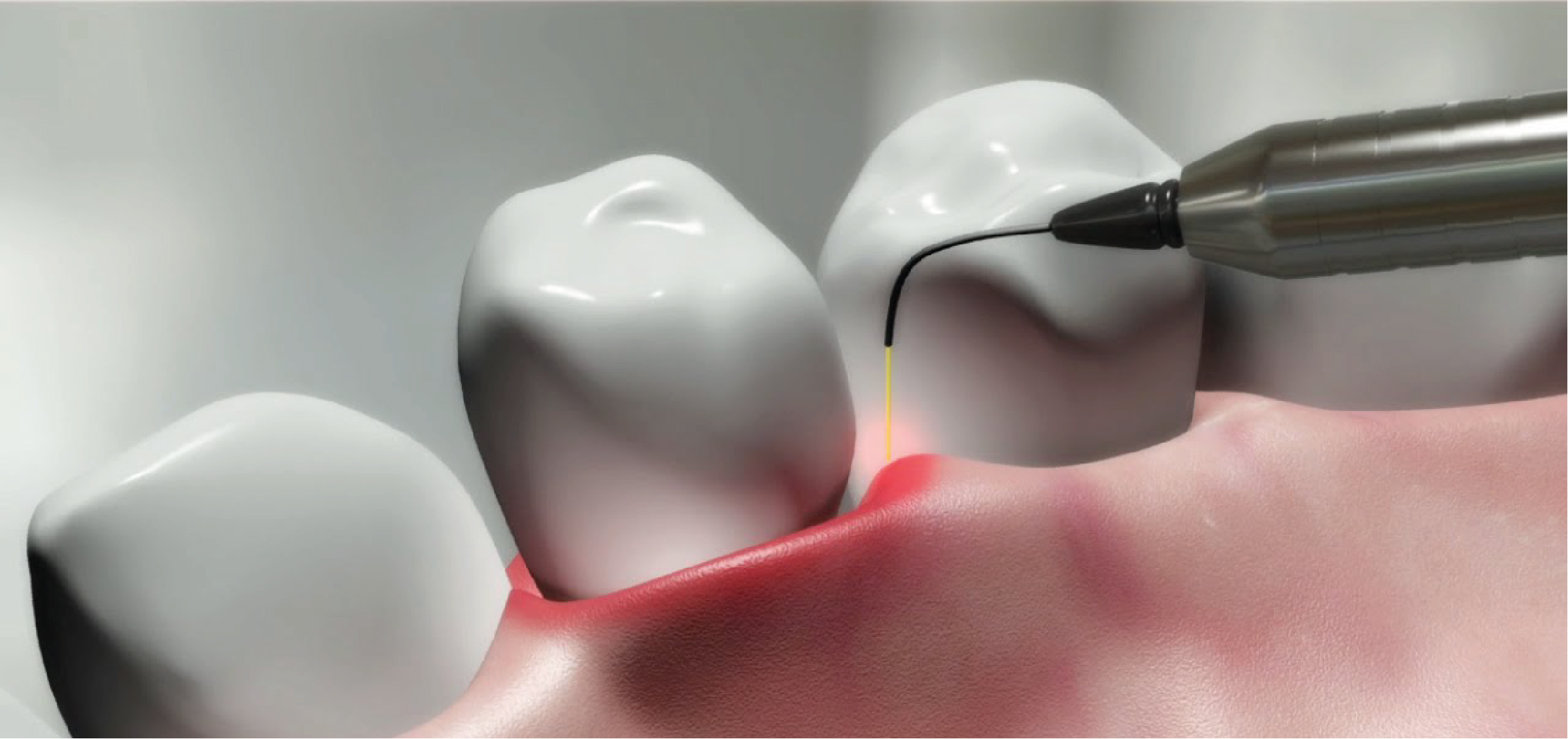 pobre cuerda Aplicando laser quirurgico | Dental Tonal