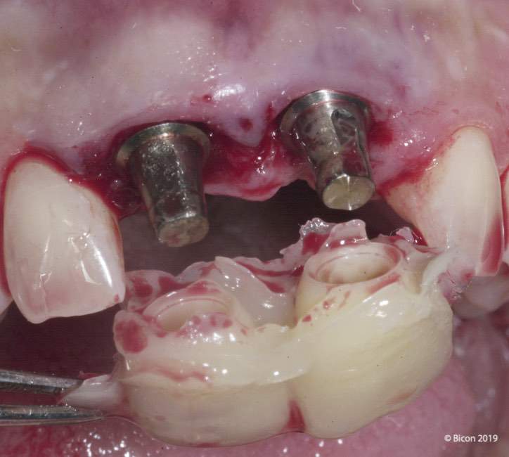 toda la vida posibilidad lotería 28. Retirada de la prótesis temporal para su pulido. | Dental Tonal