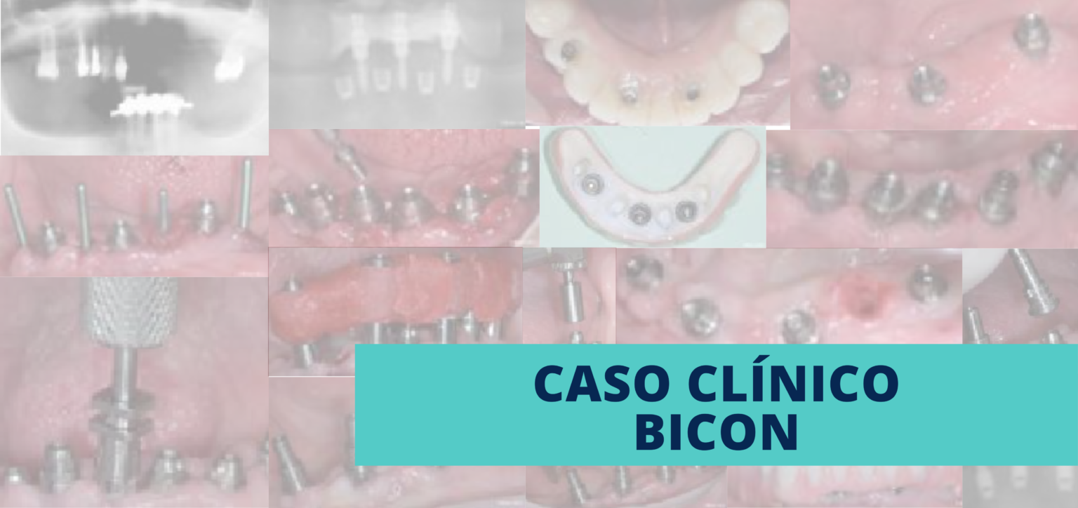 Descubrimiento de cuatro implantes Bicon SHORT® | Dental Tonal
